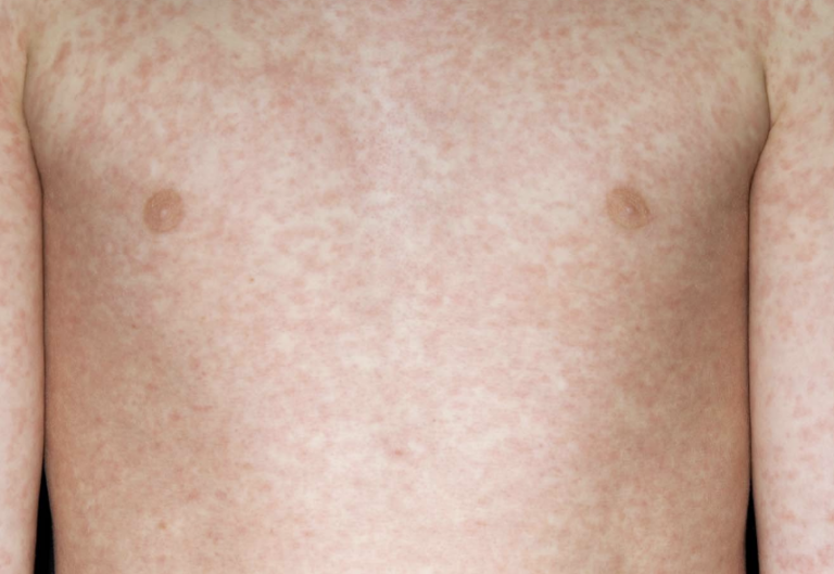 Two Children Die from Measles Amid UK Case Surge