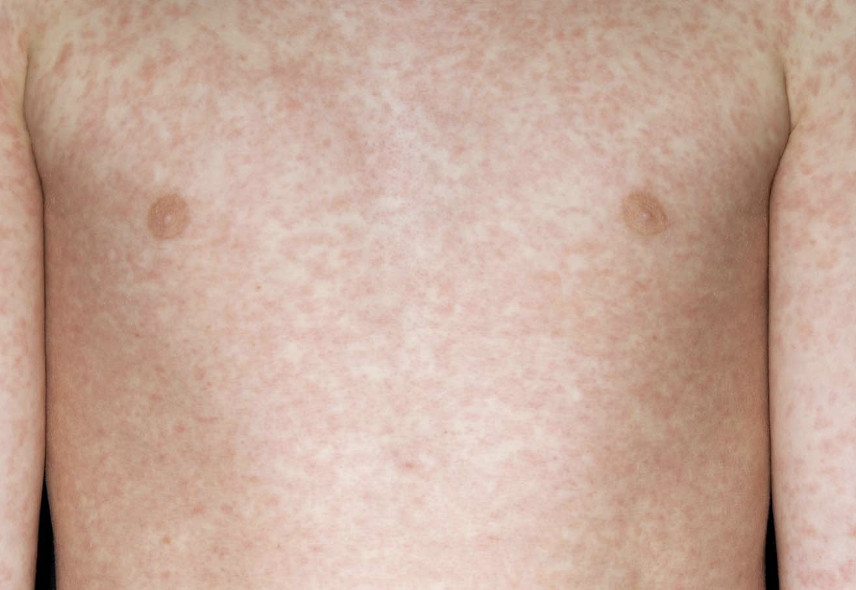Two Children Die from Measles Amid UK Case Surge
