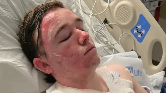 McDonald’s Employee in ICU Following Assault with Hot Oil by Co-Worker